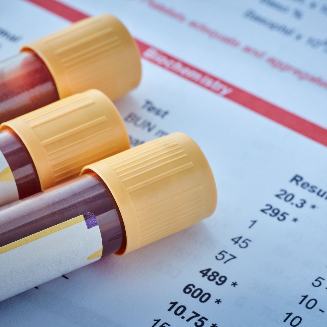 Symbolbild für erhöhten Homocysteinspiegel und natürliche Maßnahmen zur Senkung durch Ernährung und Vitamine.